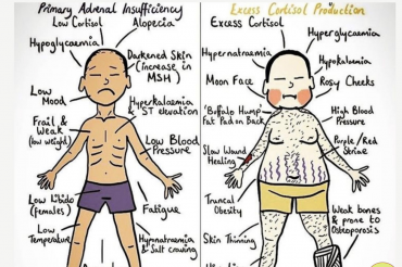 PHÂN BIỆT HỘI CHỨNG ADDISON VÀ CUSHING